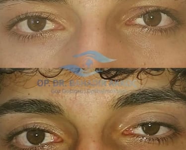 Antalyada pitozis yapan doktor dr.bahadır akkoç