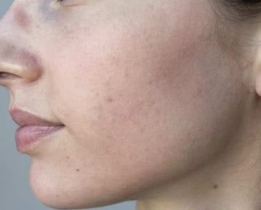 before mcironeedling results after 4 procedures