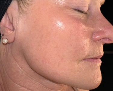 after mcironeedling results after 4 procedures
