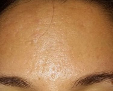after mcironeedling results after 6 procedures