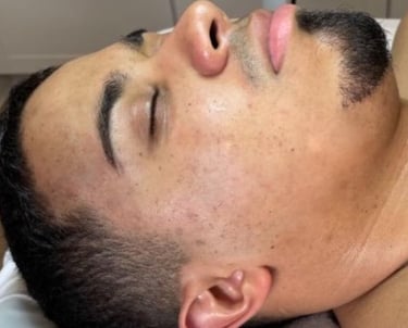 after mcironeedling results after 4 procedures
