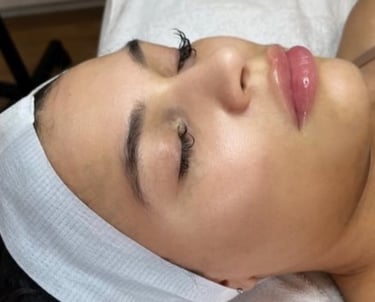 after mcironeedling results after 6 procedures
