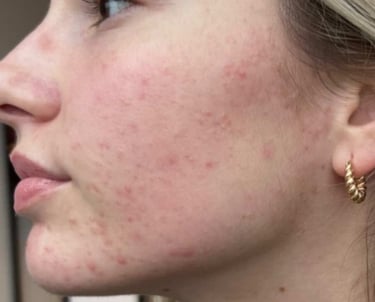 before mcironeedling results after 4 procedures