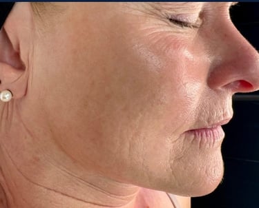 before mcironeedling results after 3 procedures