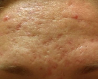 before mcironeedling results after 6 procedures