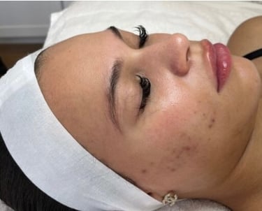 before mcironeedling results after 6 procedures