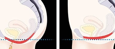 pelvic floor showing weakened versus strengthened muscles