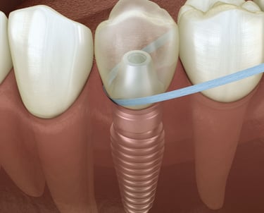 dantų implantų priežiūra