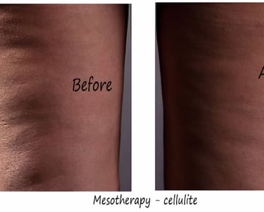 Before & after Mesotherapy Delhi – 35 yr woman with cellulite thigh, smoother skin after 1 session