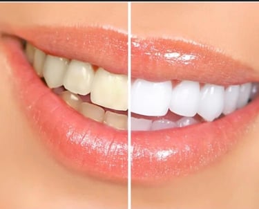 teeth whitening with laser
