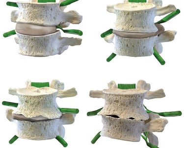 Figura mostrando o envelhecimento da coluna , a espondilodiscopatia degenerativa