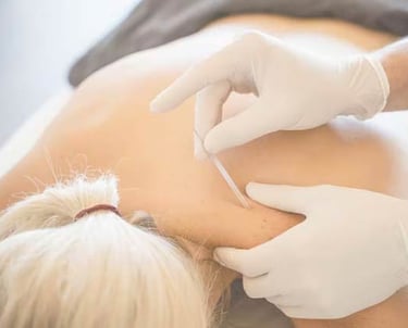 Dry needling being performed