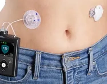 Patient using insulin pump device for diabetes management at Asian Diabetes Center Madinaguda Hyd