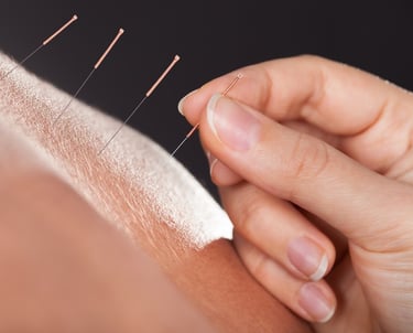 Acupuncture