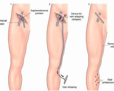 varicose veins surgery