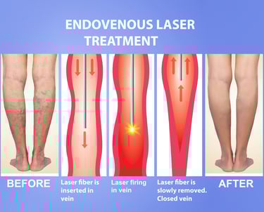 العلاج بالليزر الداخلي (Endovenous Laser Therapy - EVLT)