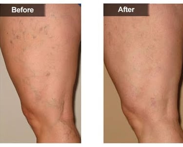 Varicose veins jordan