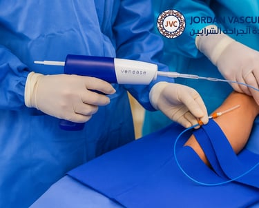 العلاج  venanseal لدوالي الساقين د. عمر نادر يونس حمدالله