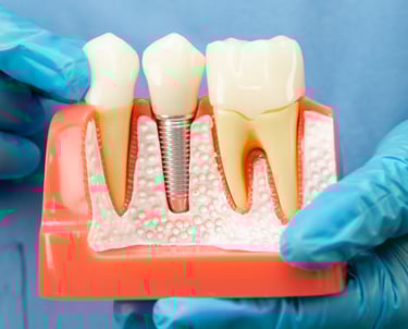 زراعة الأسنان - عيادة طب الاسنان دكتور وسام علي العباسي