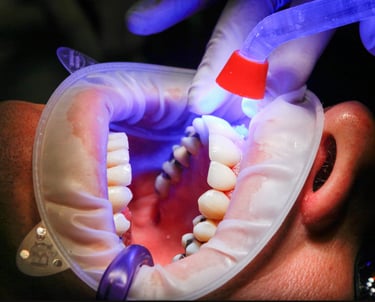 زراعة الأسنان - عيادة طب الاسنان دكتور وسام علي العباسي