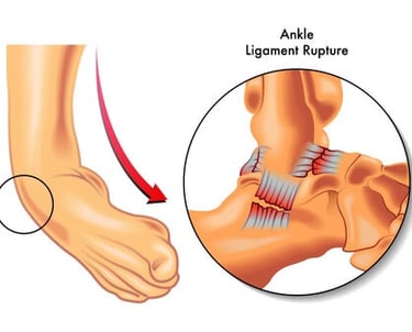 ankle sprain treatment
