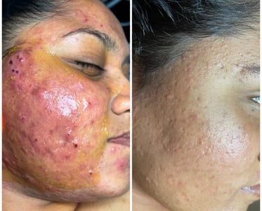 Clearer skin before and after acne treatment in Kandy clinic