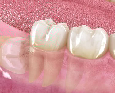 extraccion de cordales sin dolor