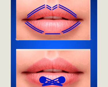 Técnica de preenchimento labial