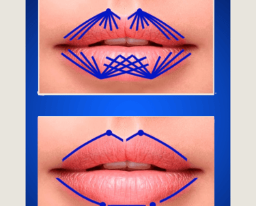 Técnica de preenchimento labial