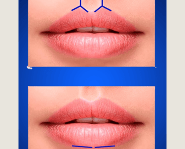 Técnica de preenchimento labial