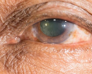 a close up of a person's eye with an eye with cataract