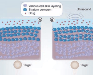 TED uses low-frequency ultrasound waves that creates microbubbles in the scalp