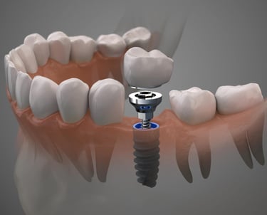Implantes Dentales en Santo Domingo
