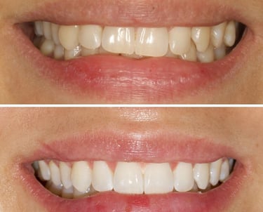 Antes e depois de tratamento com Alinhadores Invisíveis