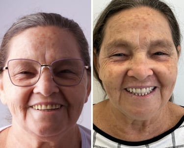 Antes e depois de tratamento com prótese protocolo