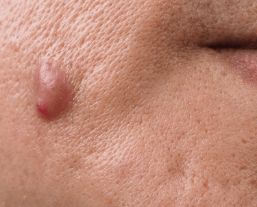 xérese de Cistos Sebáceos, Lipomas e Nevus