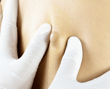 Retorno pós-operatório com orientações de curativo após cirurgia de cisto pilonidal.