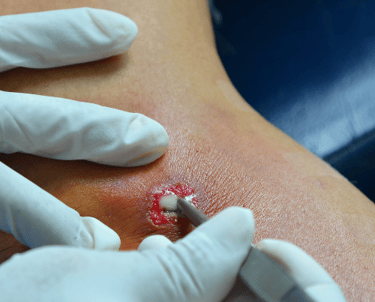 Drenagem de Abscessos