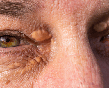 Close-up de pálpebra com xantelasma amarelo no canto interno, fundo neutro suave.