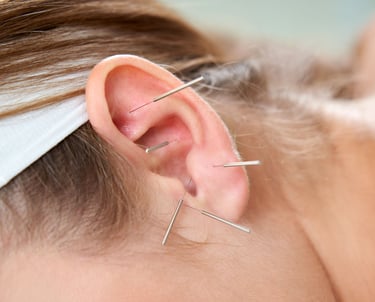 pontos de auriculoterapia com agulhas