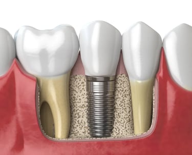 Impianto dentale dente