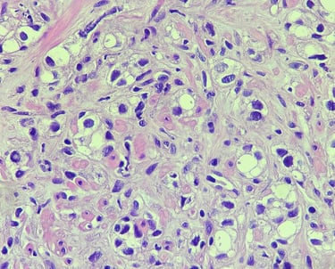 câncer de próstata, uropatologia, Gleason