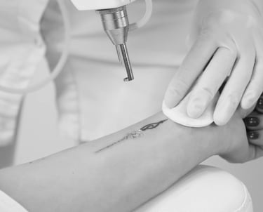 a woman getting a tattoo removed on her wrist