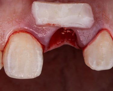 Bone graft