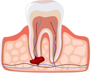 dental cyst