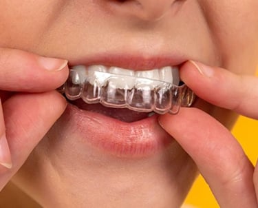 transparent dental aligner
