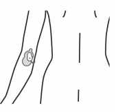 Diagram of Painmaster patches on the back of the elbow.
