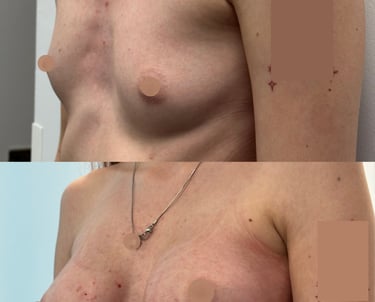Breast augmentation (implant surgery) illustration from Macys Plastic Surgery Manchester