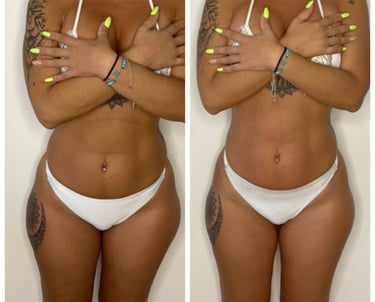 Body contouring before and after results at-home sculpting treatment NYC by SkinBeautyElite. 