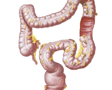 Tratamientos de coloproctologia en diverticulos del colon y colonoscopia. 
